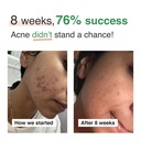 beyond-clear-skin-acne-supplement-for-wo-71DEhyt0AKL.jpg