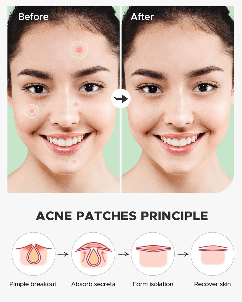 vowel-s-acne-pimple-patch-hydrocolloid-a-71PU911wo0L.jpg