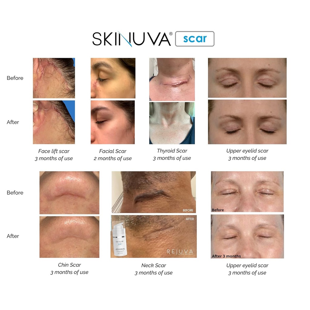 skinuva-next-generation-scar-cream---adv-6.jpg