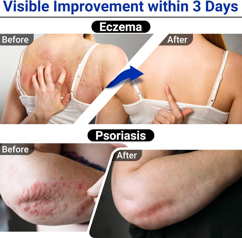 eczema-cream-maximum-strength-treatment--4.jpg