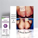loma-lux-psoriasis-relief-natural-wminer-5.jpg