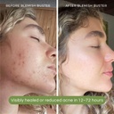sonya-dakar-blemish-buster---acne-spot-t-6.jpg