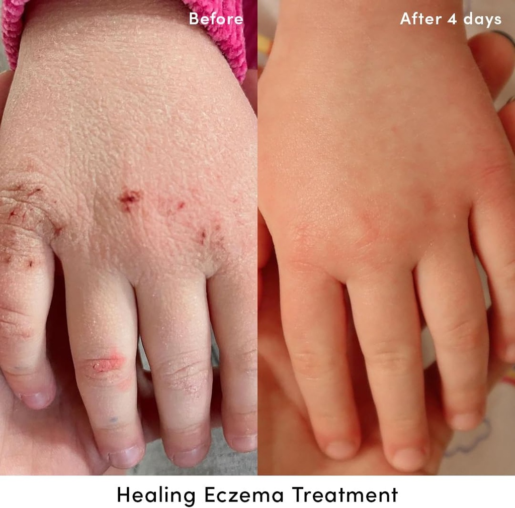 evereden-healing-eczema-treatment-17-fl--2.jpg
