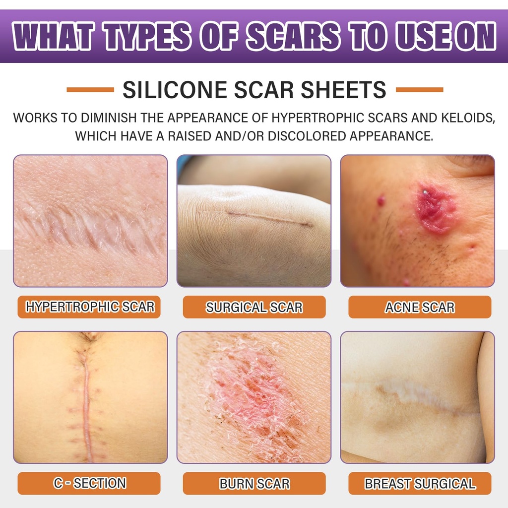 silicone-scar-sheets-silicone-scar-tape--2.jpg
